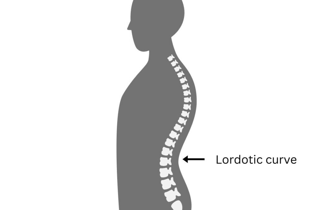 Do you have Lordosis?